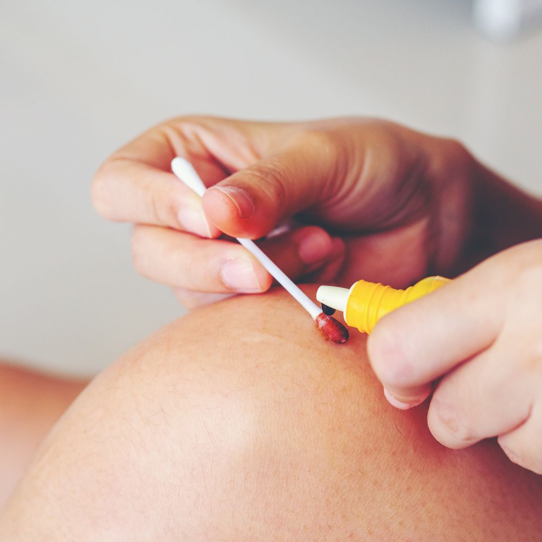 Person applying antiseptic to a small cut on their knee using a cotton swab and a yellow bottle.
